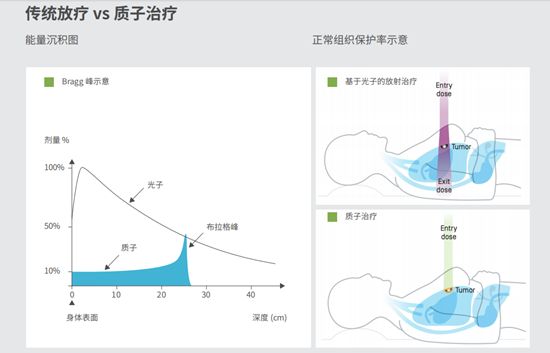 改变宫颈癌治疗命运 河北一洲肿瘤医院质子治疗的实践探索